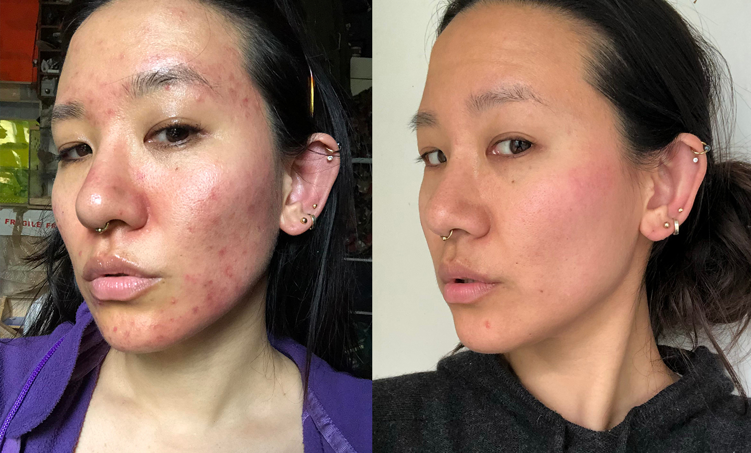 Acne Skin Journey: Sakiko, 37, London - SkinLab